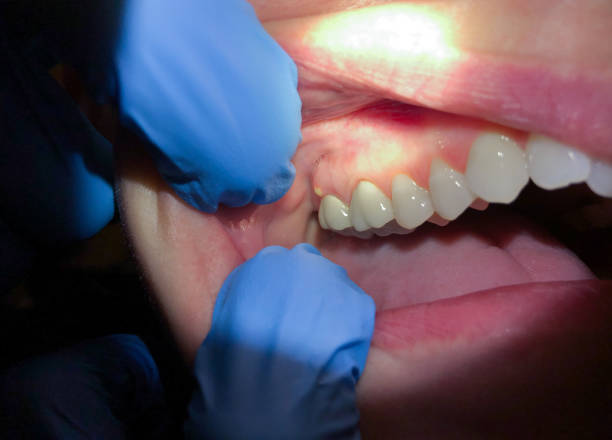 Best Emergency Denture Repair in Mount Carmel, OH